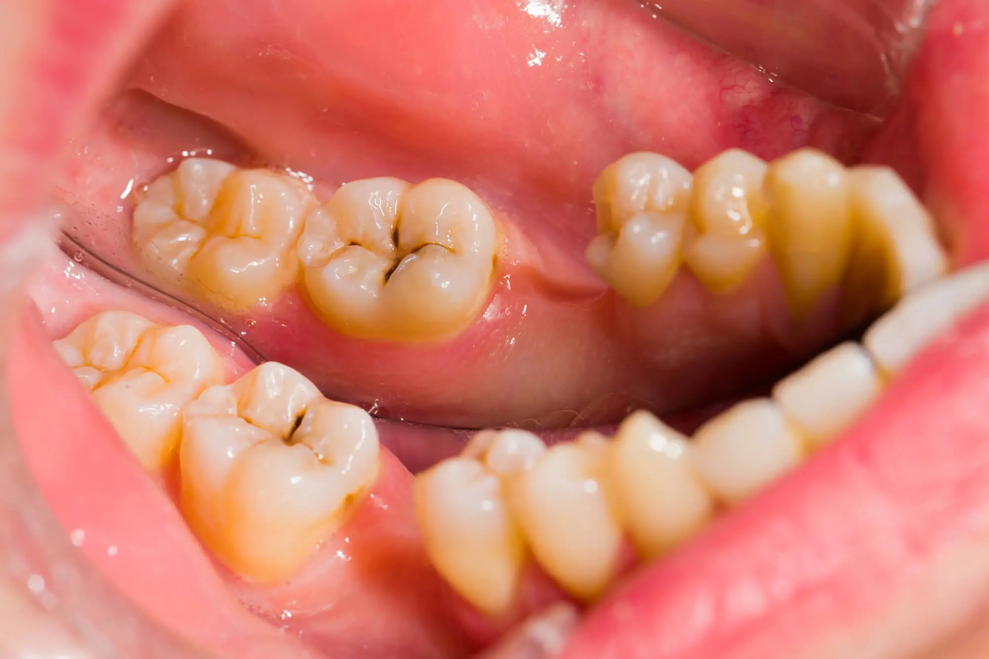 Dentista Que Hable Español en Lake Worth Explica Cómo Identificar Caries
