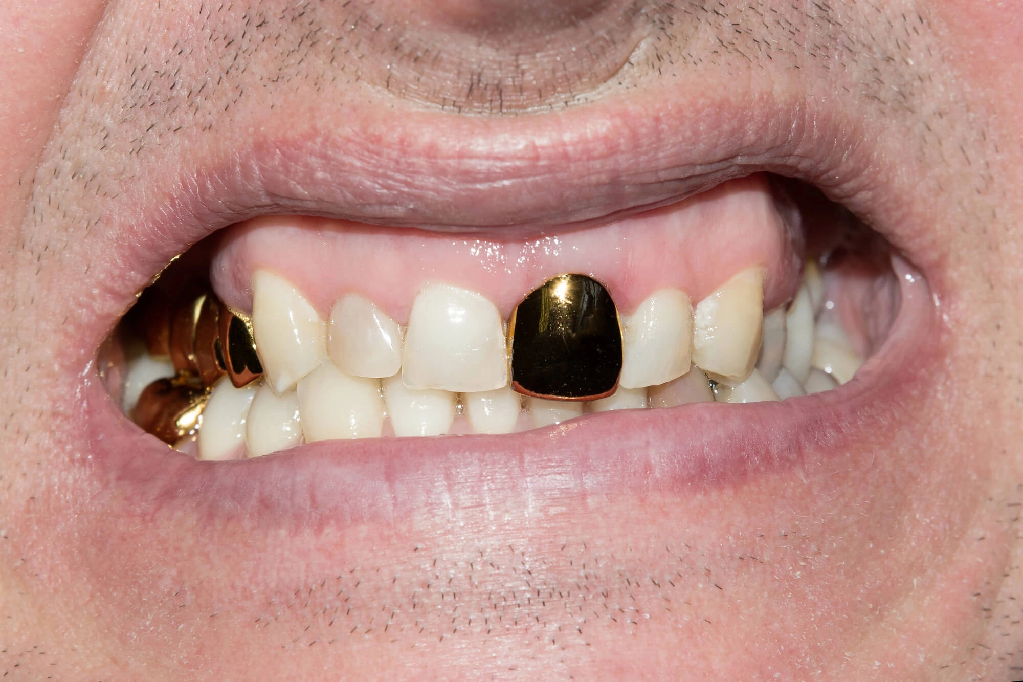 Metal Dental Crowns in Lake Worth