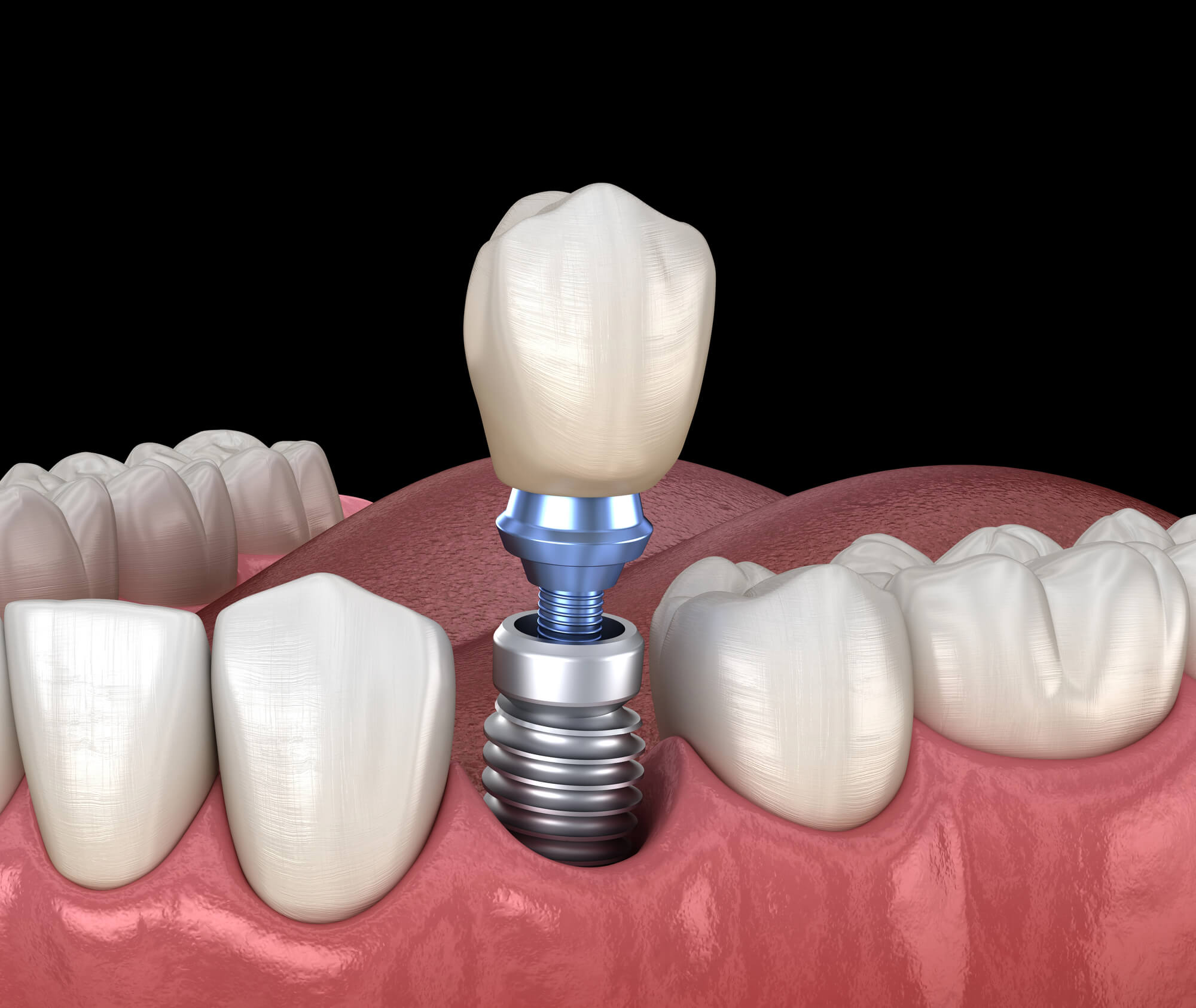 Dentista que Hable Español en Lake Worth y Coloque Implantes Dentales