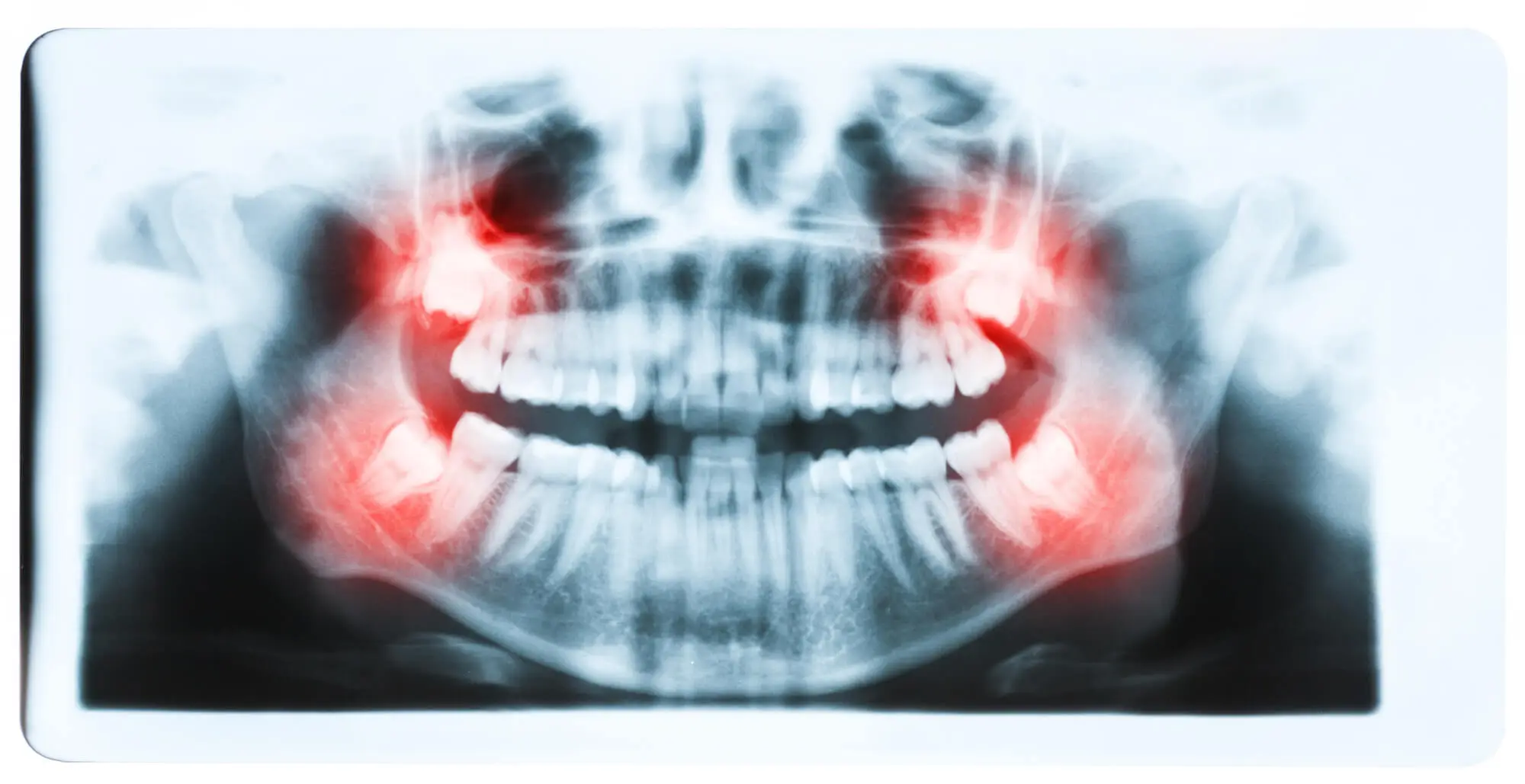 Dentista que Hable Español en Lake Worth que Extrae Muelas de Juicio