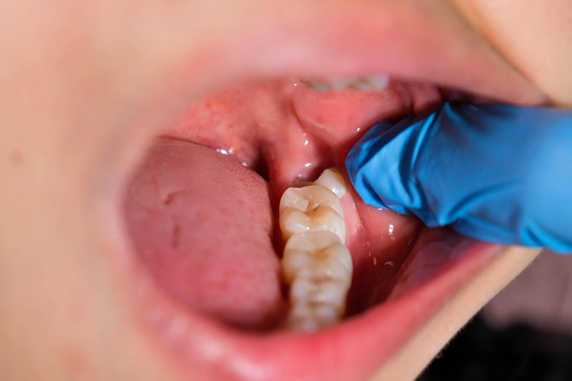 Visita al Dentista que Hable Español en Lake Worth si Tienes Una Muela de Juicio Impactada