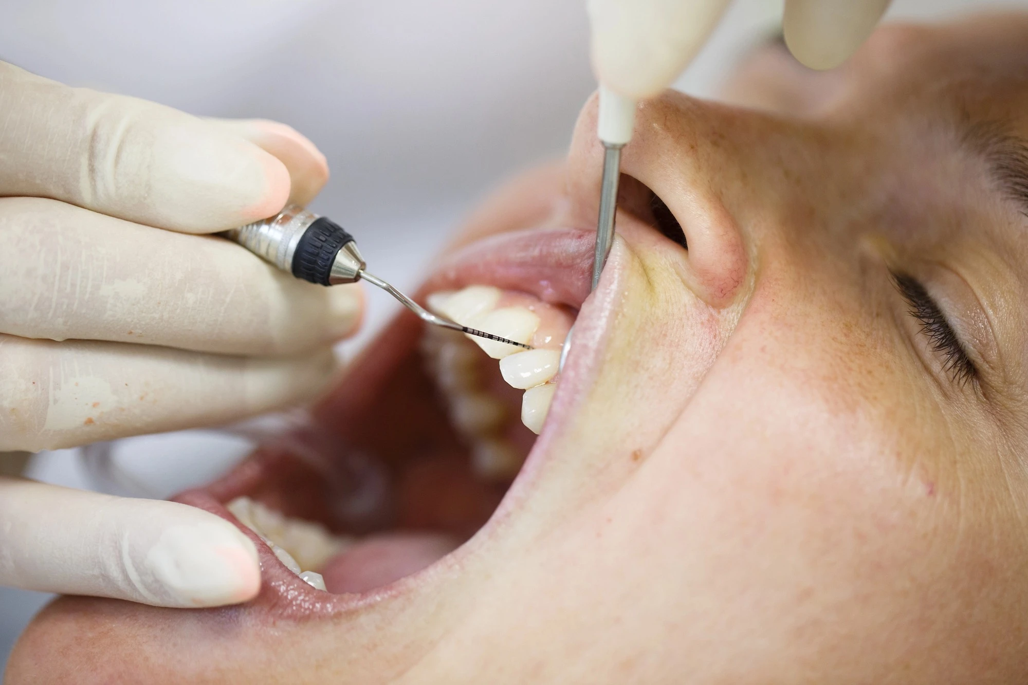 root-canal-therapy-lake-worth-patient-treatment-closeup