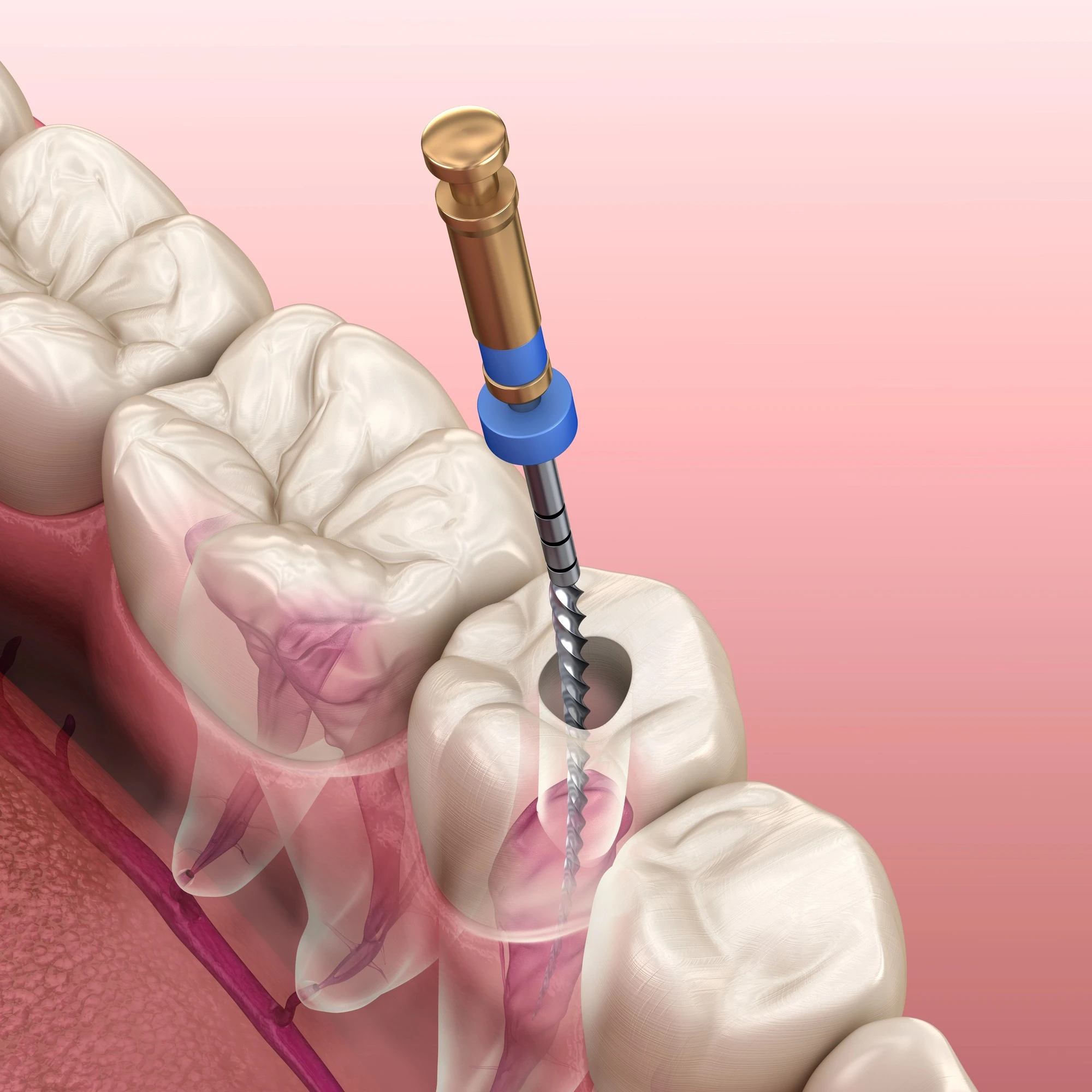 root-canal-therapy-lake-worth-root-canal-procedure-diagram