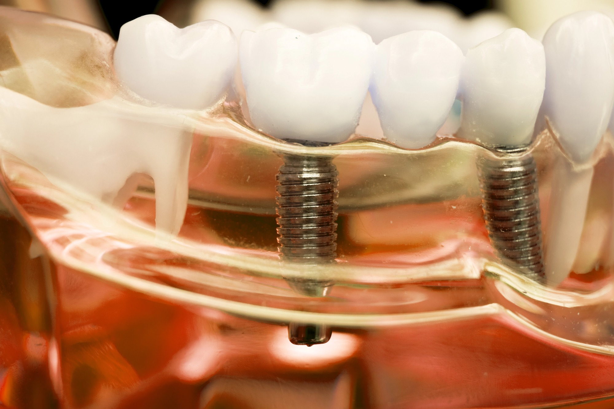 dental implants boynton beach multiple implant restoration