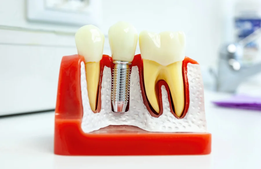 dental-implants-lake-worth-implant-model