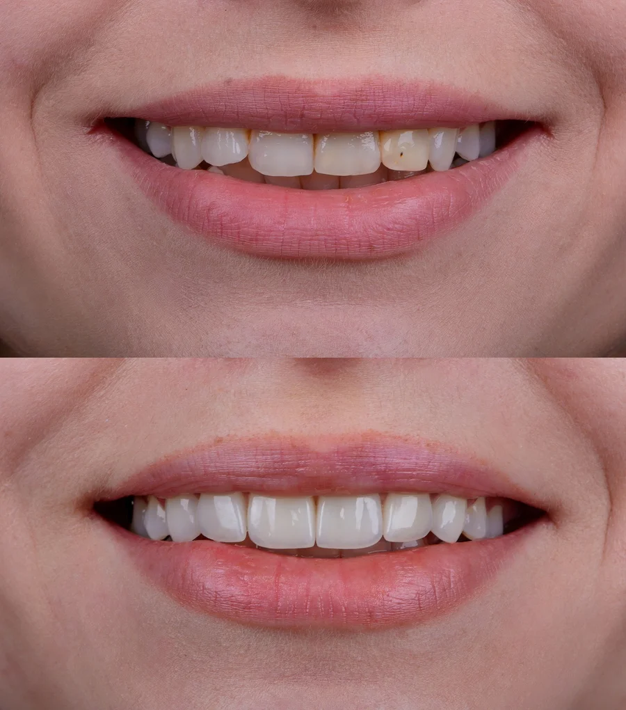 before and after cosmetic dentistry smile makeover lake worth fl