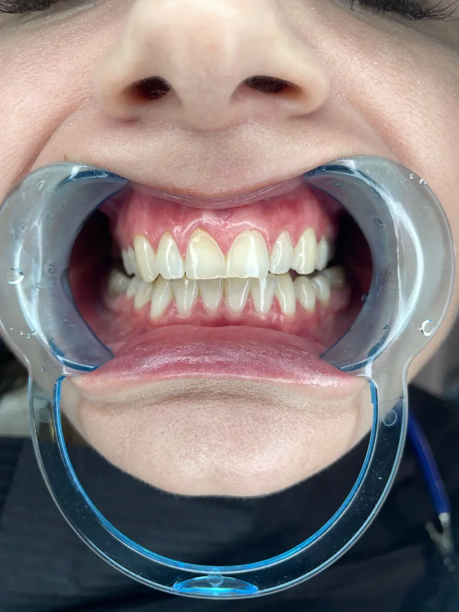 teeth-whitening-lake-worth-close-up-of-teeth-with-cheek-retractor-in-place